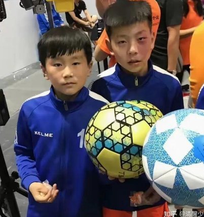 梅斯19岁足球小将冲入火场救出女友，他全身三成皮肤被烧伤
